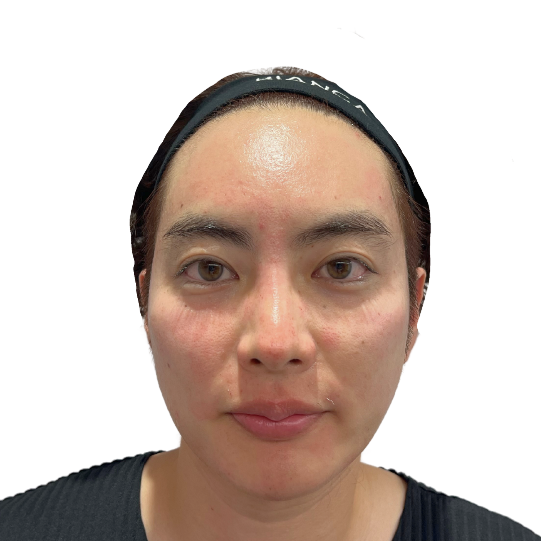 マヌカフェイシャル（ダーマペン4）